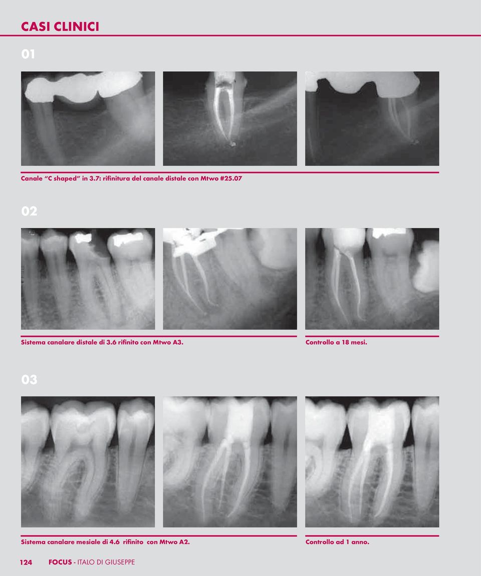 07 02 Sistema canalare distale di 3.6 rifinito con Mtwo A3.