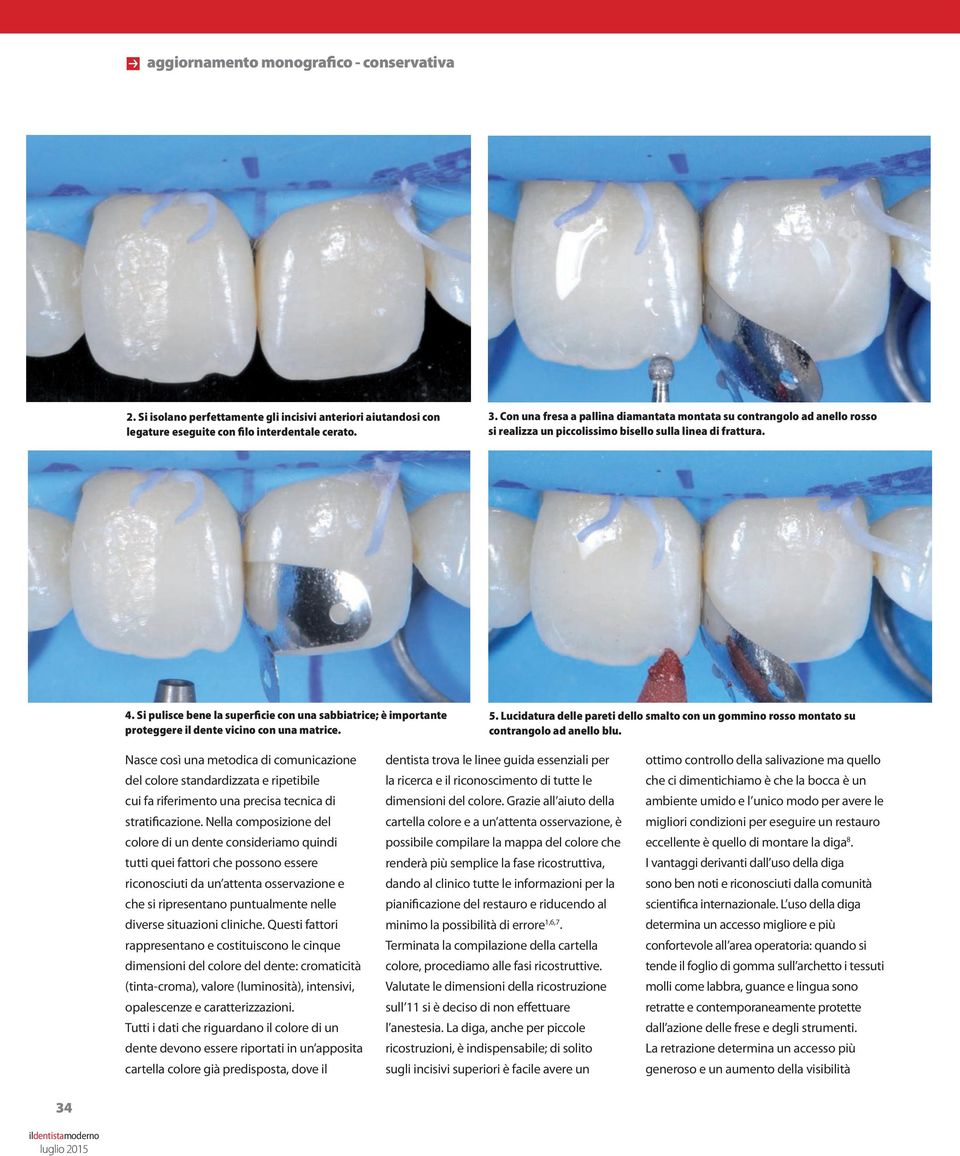 Si pulisce bene la superficie con una sabbiatrice; è importante proteggere il dente vicino con una matrice. 5.