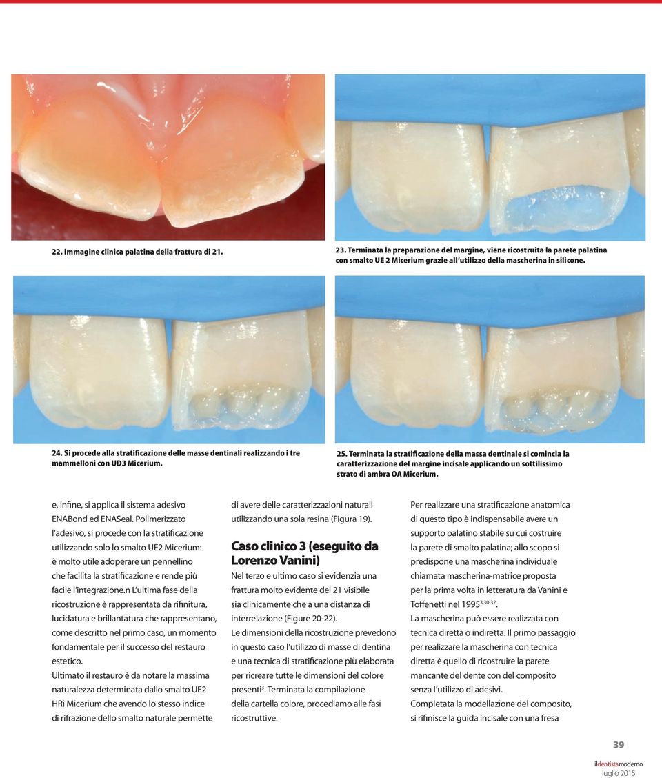Si procede alla stratificazione delle masse dentinali realizzando i tre mammelloni con UD3 Micerium. 25.
