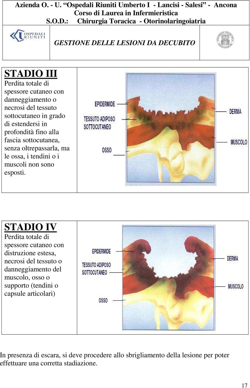 STADIO IV Perdita totale di spessore cutaneo con distruzione estesa, necrosi del tessuto o danneggiamento del muscolo, osso o