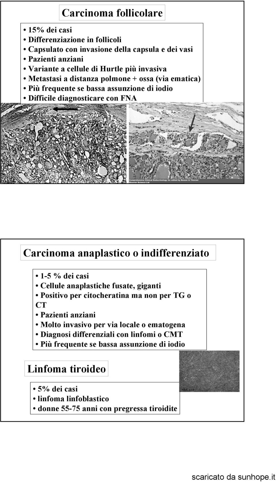 indifferenziato 1-5 % dei casi Cellule anaplastiche fusate, giganti Positivo per citocheratina ma non per TG o CT Pazienti anziani Molto invasivo per via locale o