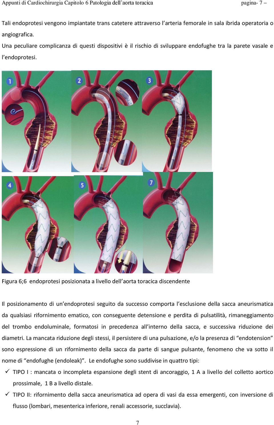 Figura 6;6 endoprotesi posizionata a livello dell aorta toracica discendente Il posizionamento di un endoprotesi seguito da successo comporta l esclusione della sacca aneurismatica da qualsiasi
