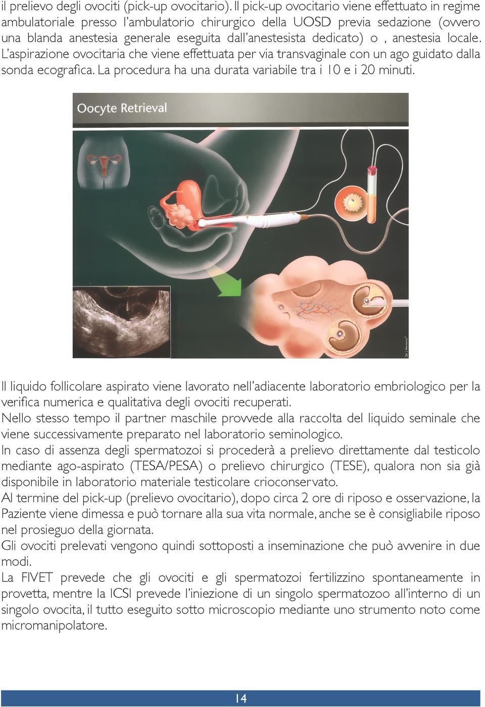 anestesia locale. L aspirazione ovocitaria che viene effettuata per via transvaginale con un ago guidato dalla sonda ecografica. La procedura ha una durata variabile tra i 10 e i 20 minuti.