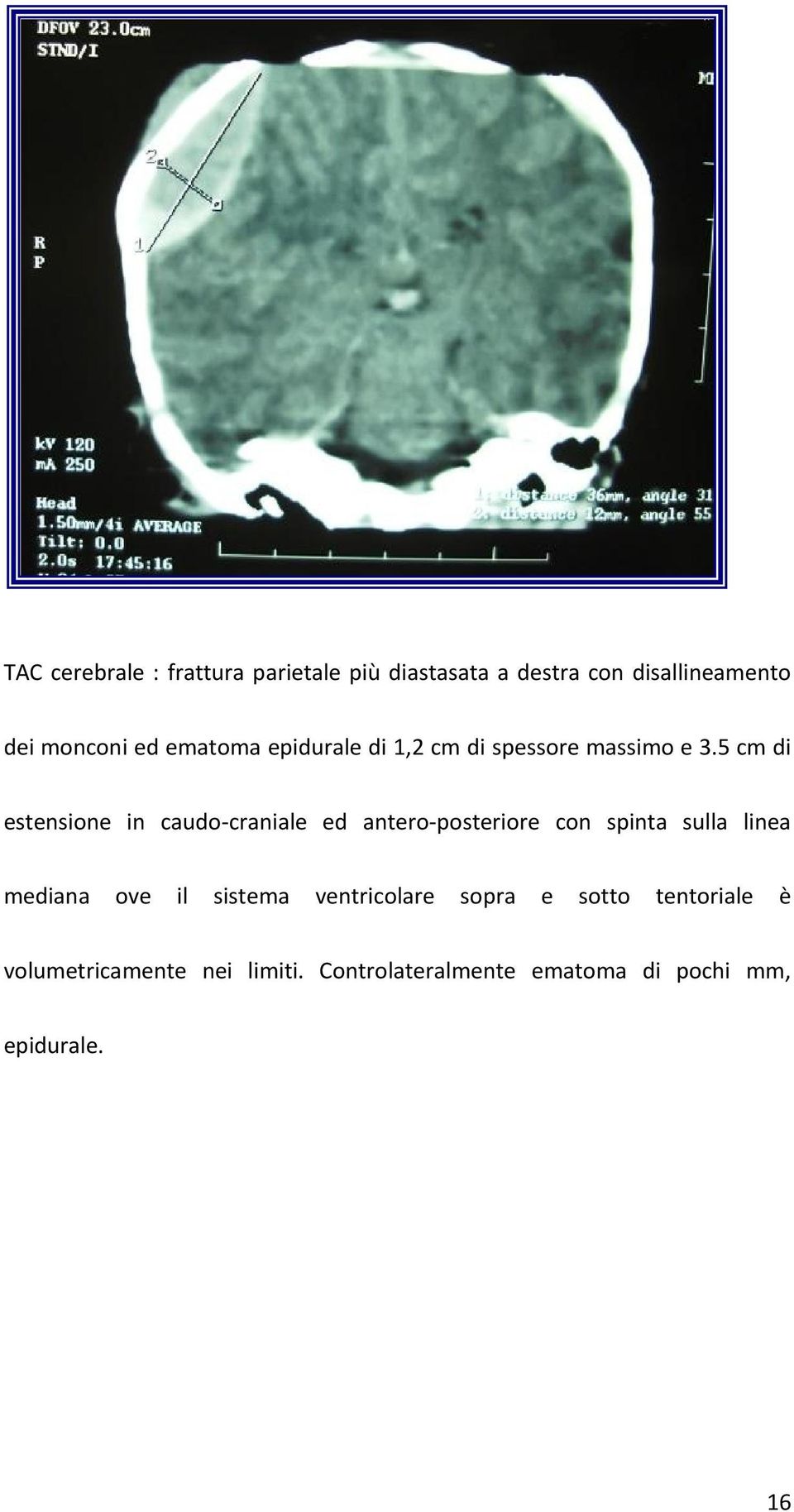 5 cm di estensione in caudo-craniale ed antero-posteriore con spinta sulla linea mediana ove