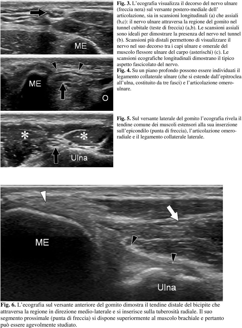 regione del gomito nel tunnel cubitale (teste di freccia) (a,b). Le scansioni assiali sono ideali per dimostrare la presenza del nervo nel tunnel (b).