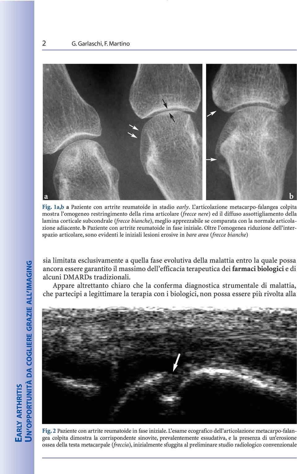 meglio apprezzabile se comparata con la normale articolazione adiacente. b Paziente con artrite reumatoide in fase iniziale.