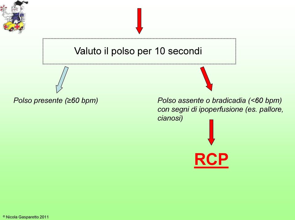 bradicadia (<60 bpm) con segni di