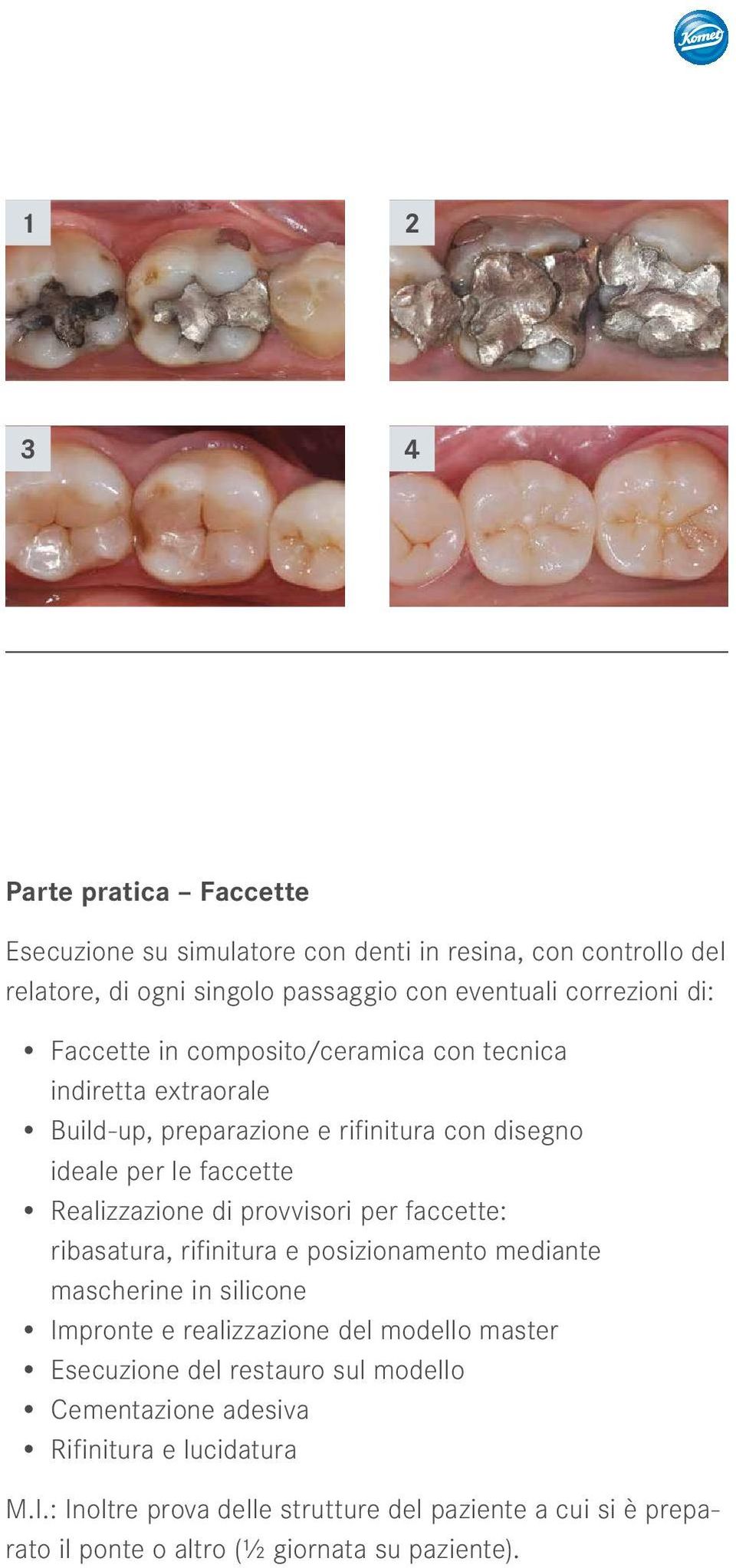 provvisori per faccette: ribasatura, rifinitura e posizionamento mediante mascherine in silicone Impronte e realizzazione del modello master Esecuzione del