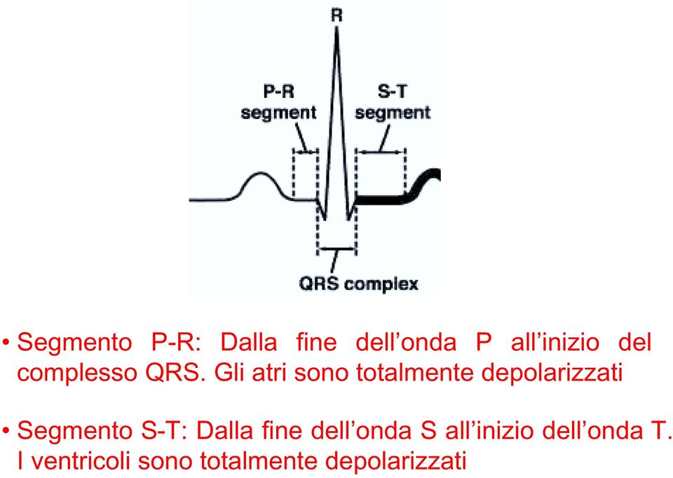 Gli atri sono totalmente depolarizzati Segmento ST: