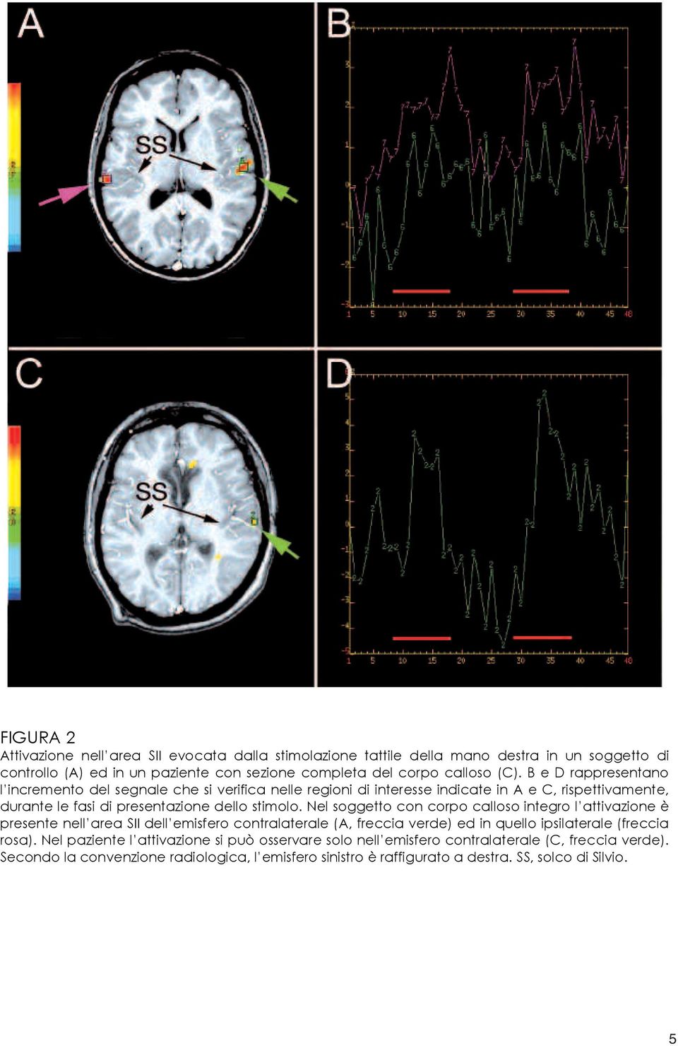 Nel soggetto con corpo calloso integro l attivazione è presente nell area SII dell emisfero contralaterale (A, freccia verde) ed in quello ipsilaterale (freccia rosa).