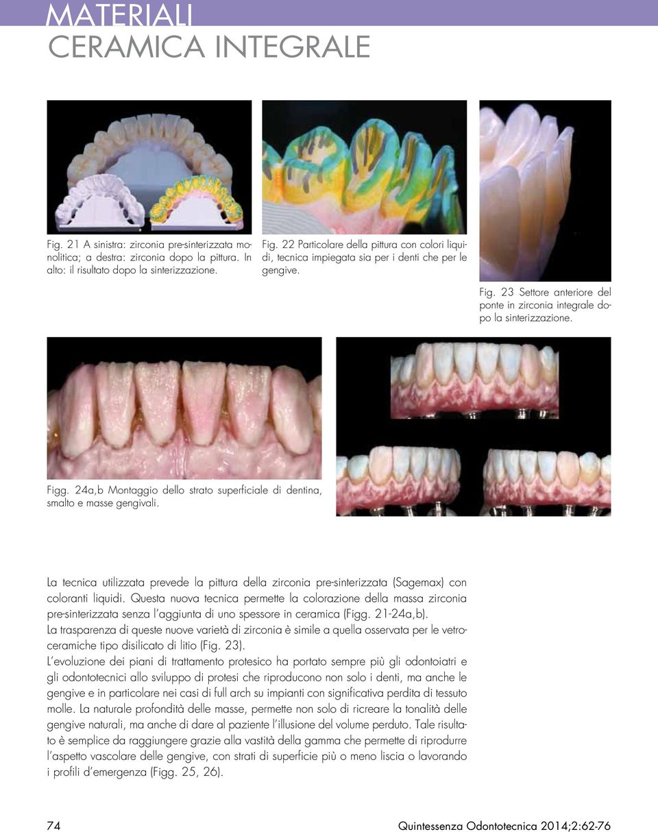 24a,b Montaggio dello strato superficiale di dentina, smalto e masse gengivali. La tecnica utilizzata prevede la pittura della zirconia pre-sinterizzata (Sagemax) con coloranti liquidi.