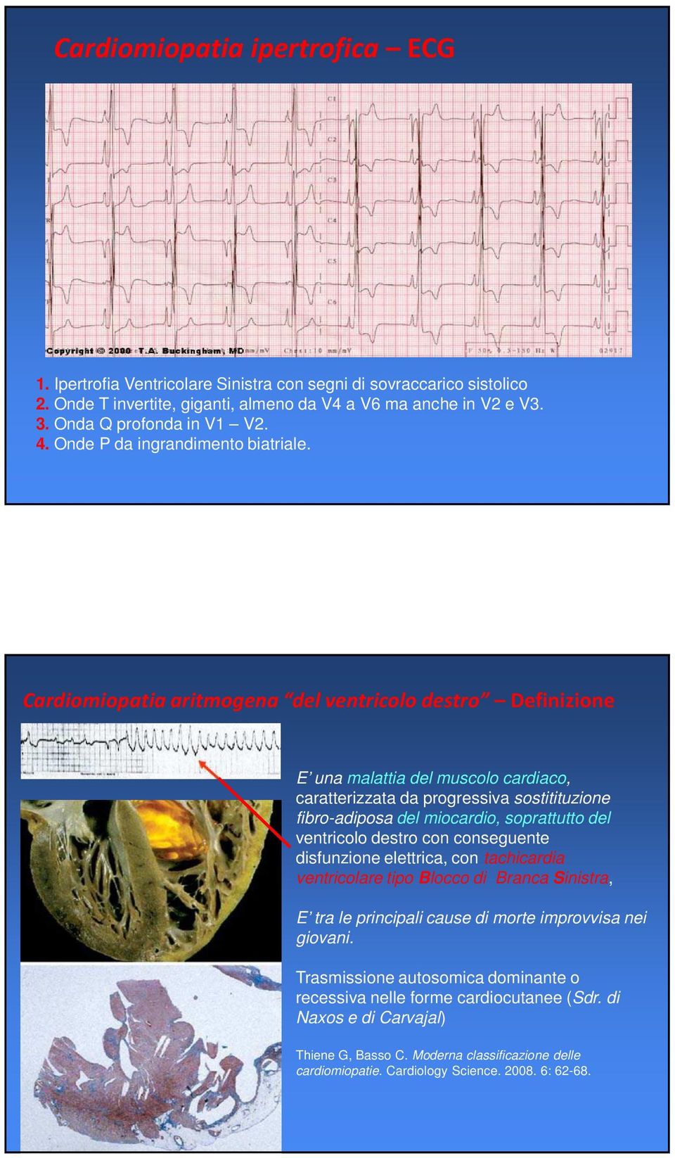 Cardiomiopatia aritmogena del ventricolo destro Definizione E una malattia del muscolo cardiaco, caratterizzata da progressiva sostitituzione fibro-adiposa del miocardio, soprattutto del ventricolo