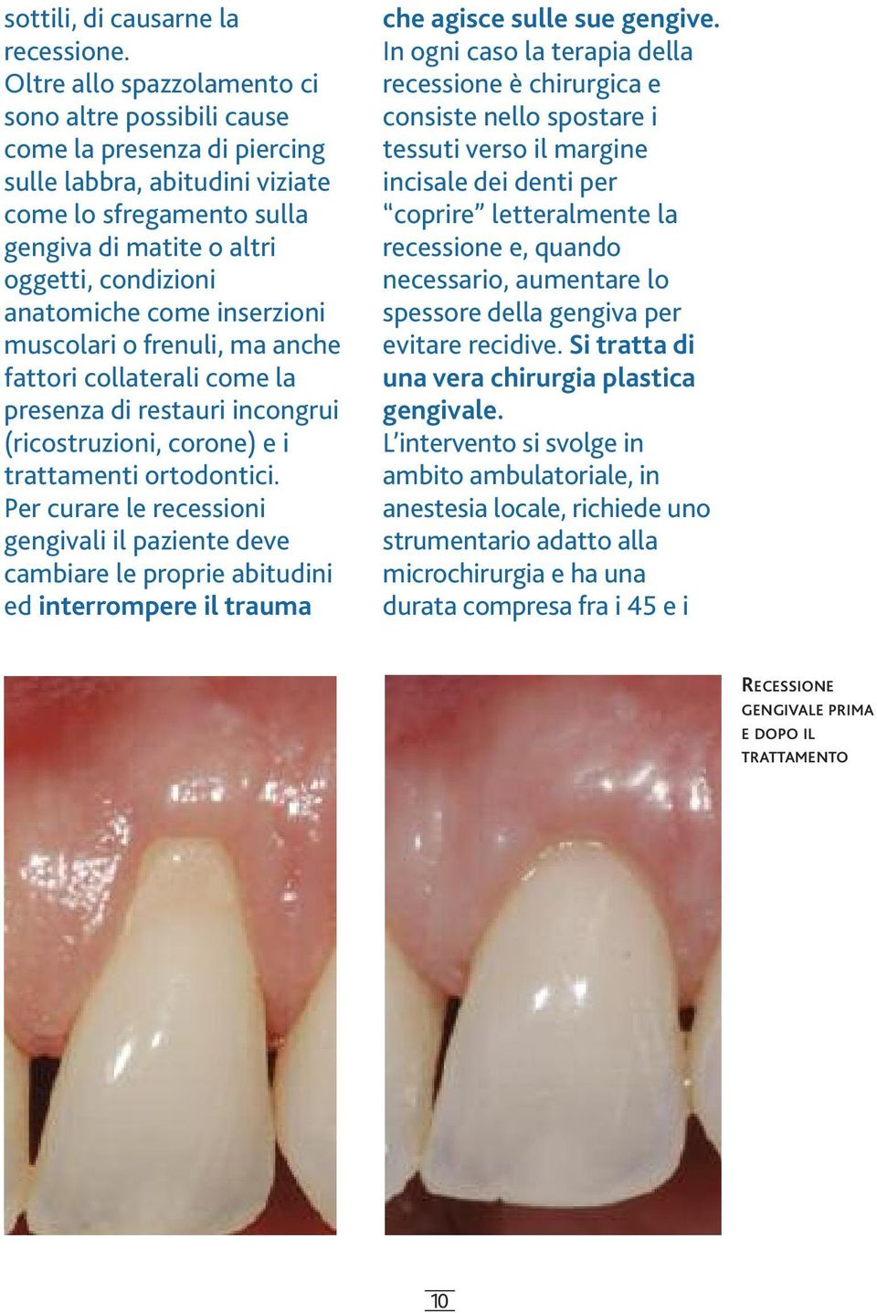 come inserzioni muscolari o frenuli, ma anche fattori collaterali come la presenza di restauri incongrui (ricostruzioni, corone) e i trattamenti ortodontici.