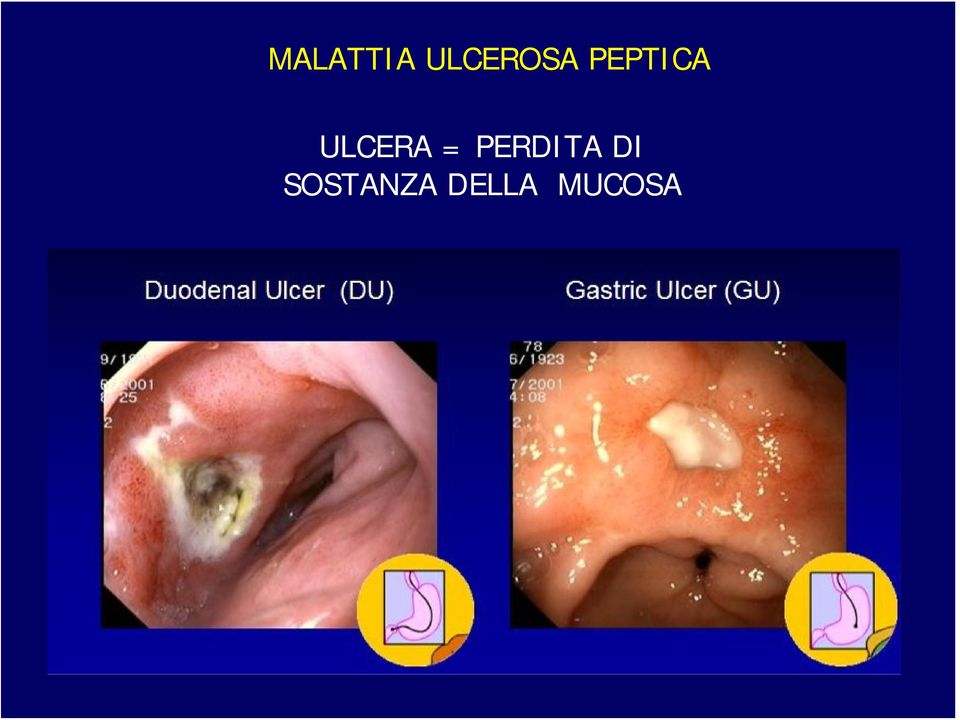 ULCERA = PERDITA