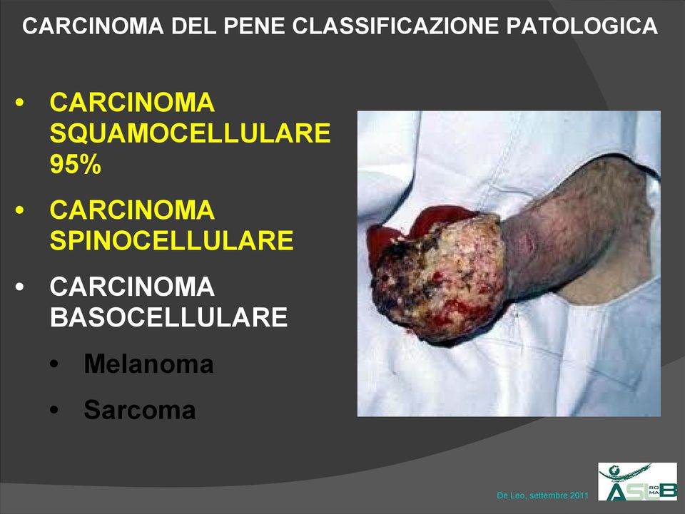 CARCINOMA SPINOCELLULARE