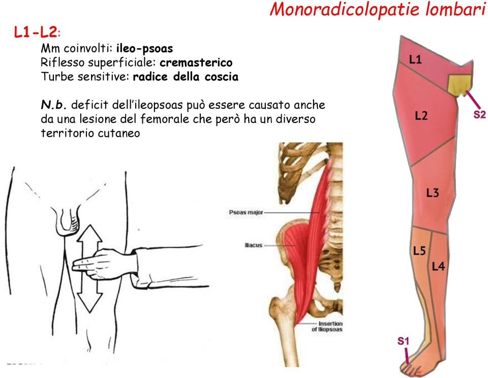 Monoradicolopatie lomba