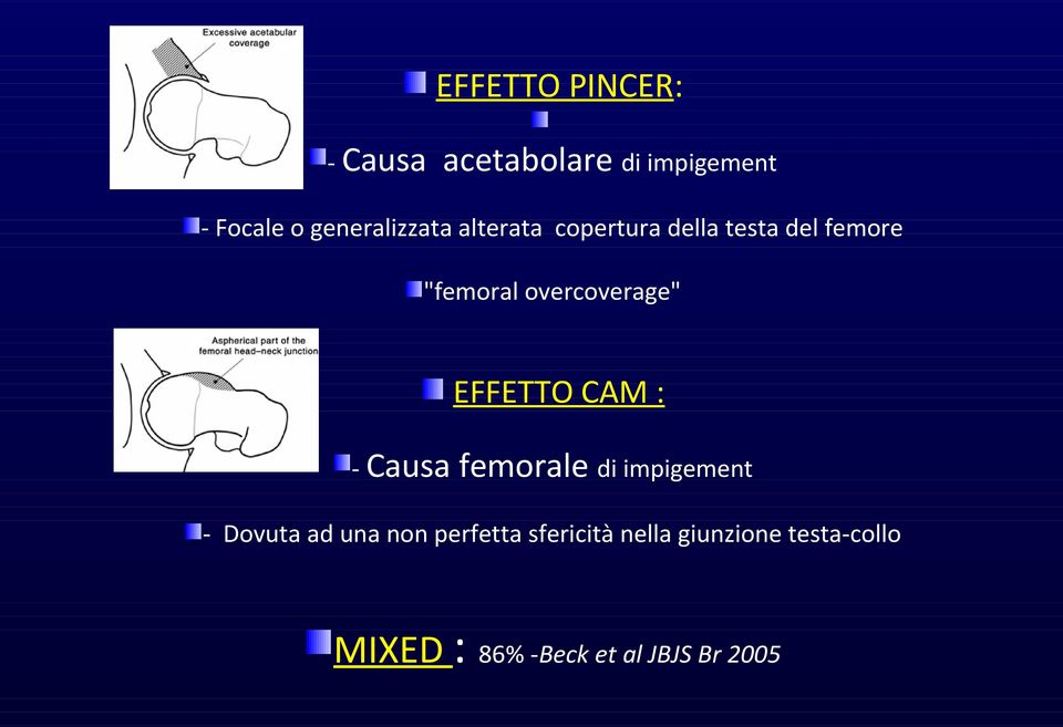 overcoverage" EFFETTO CAM : - Causa femorale di impigement - Dovuta ad