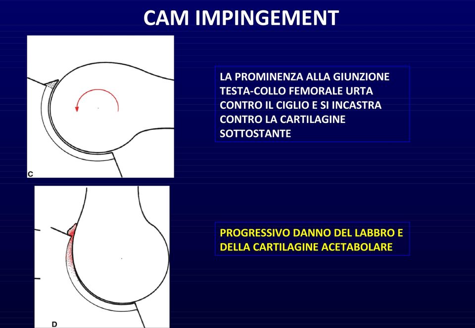 INCASTRA CONTRO LA CARTILAGINE SOTTOSTANTE