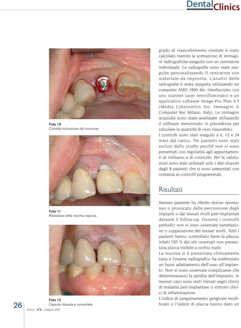 Le radiografie sono state eseguite personalizzando il centratore con materiale da impronta.