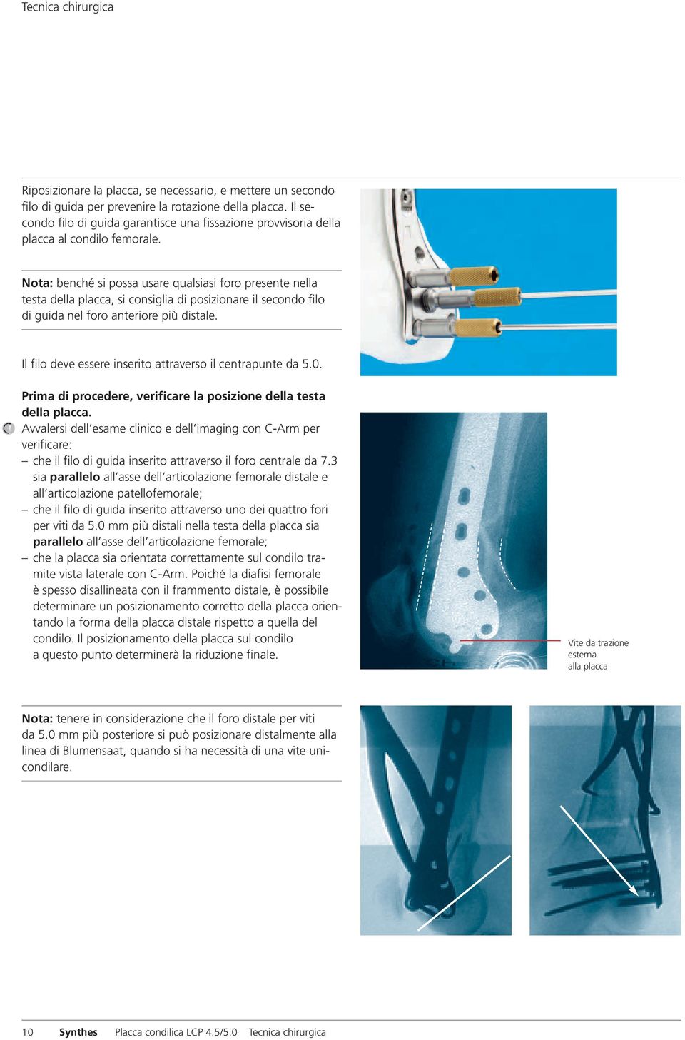 Nota: benché si possa usare qualsiasi foro presente nella testa della placca, si consiglia di posizionare il secondo filo di guida nel foro anteriore più distale.