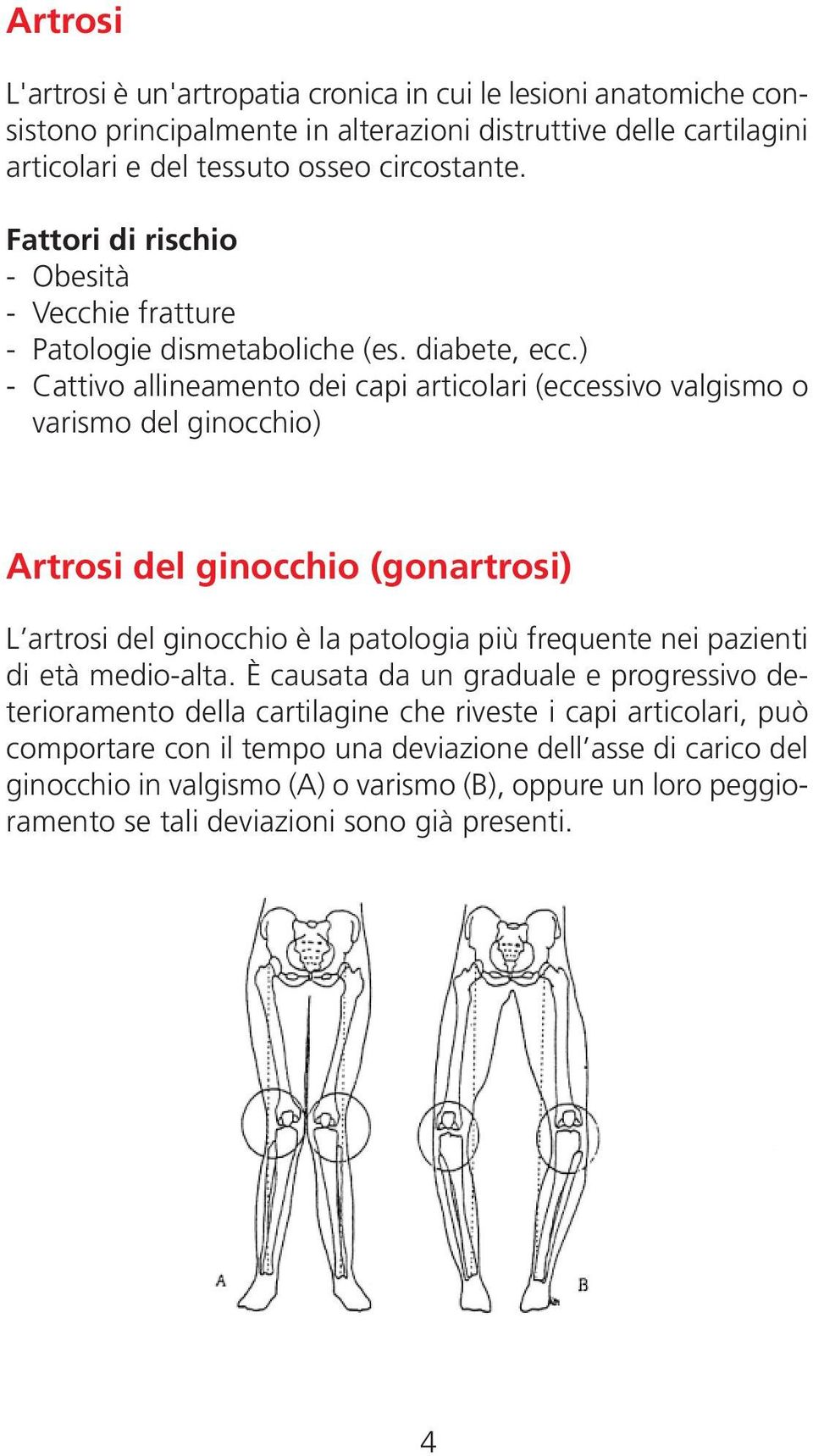 ) - Cattivo allineamento dei capi articolari (eccessivo valgismo o varismo del ginocchio) Artrosi del ginocchio (gonartrosi) L artrosi del ginocchio è la patologia più frequente nei pazienti