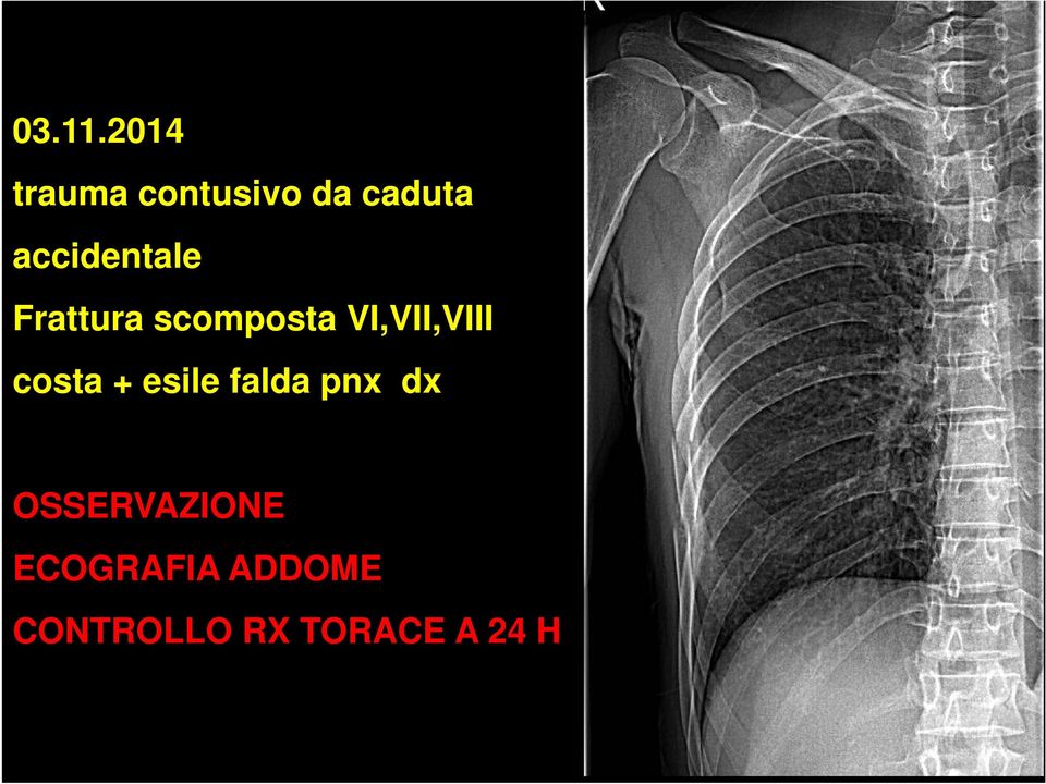 accidentale Frattura scomposta