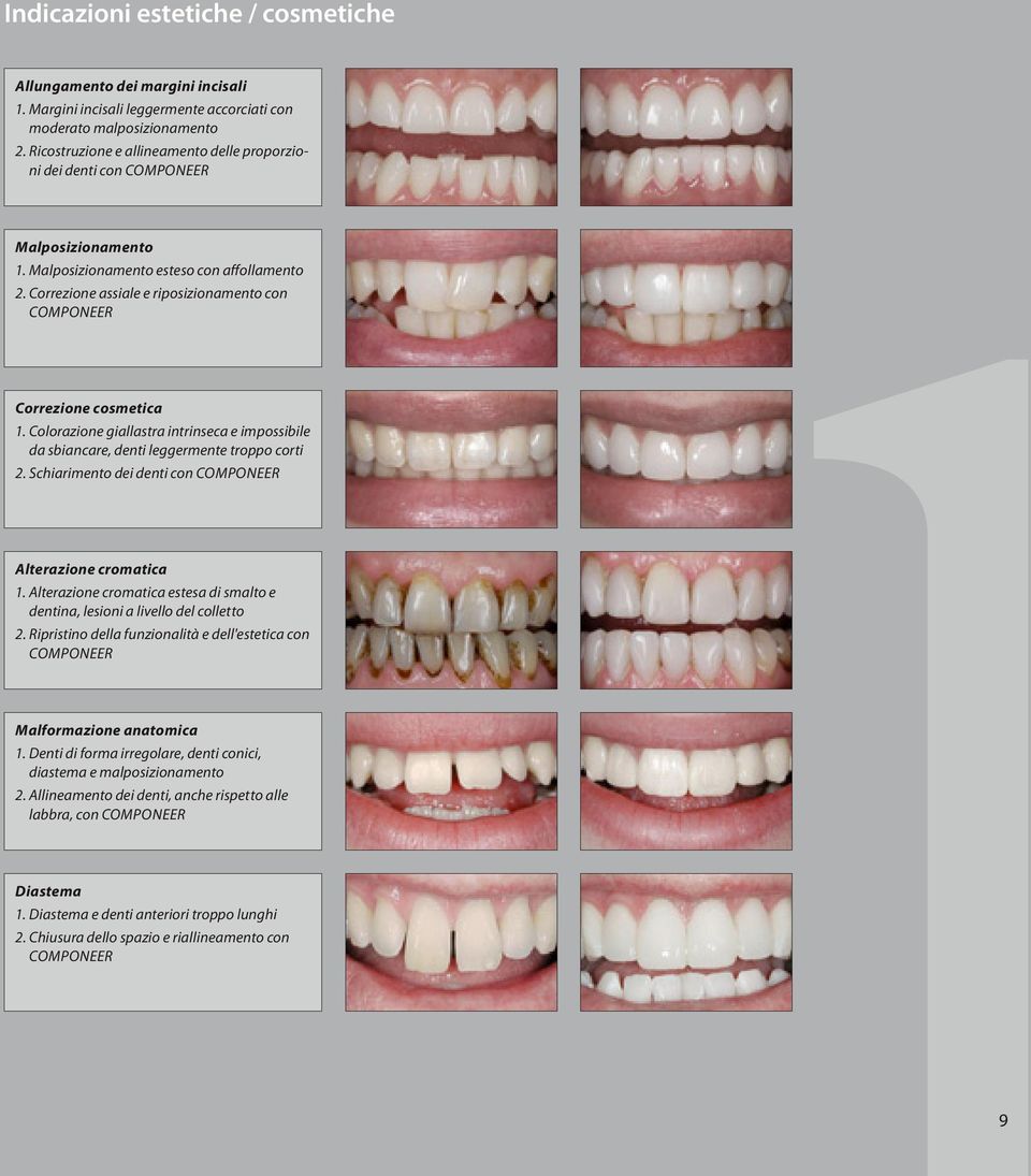 Correzione assiale e riposizionamento con Componeer Correzione cosmetica 1. Colorazione giallastra intrinseca e impossibile da sbiancare, denti leggermente troppo corti 2.