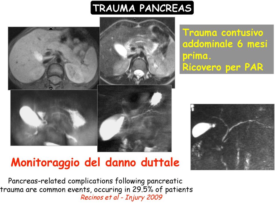 Pancreas-related complications following pancreatic trauma