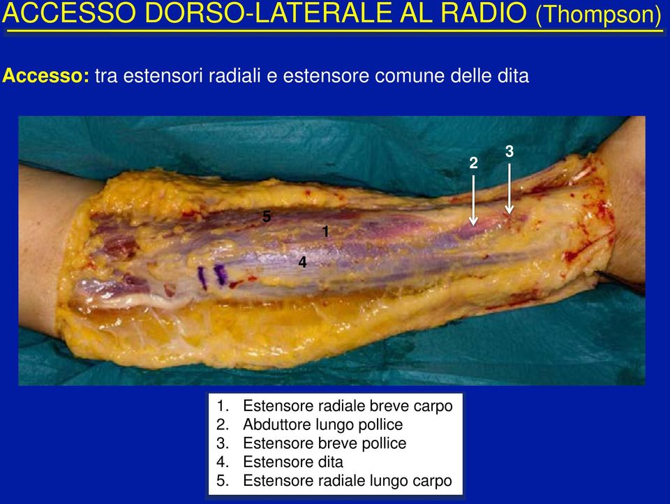 ! Estensore radiale breve carpo 2.! Abduttore lungo pollice 3.