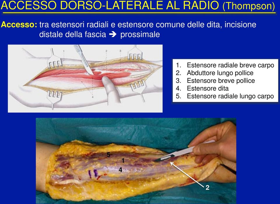 prossimale 1.! Estensore radiale breve carpo 2.! Abduttore lungo pollice 3.