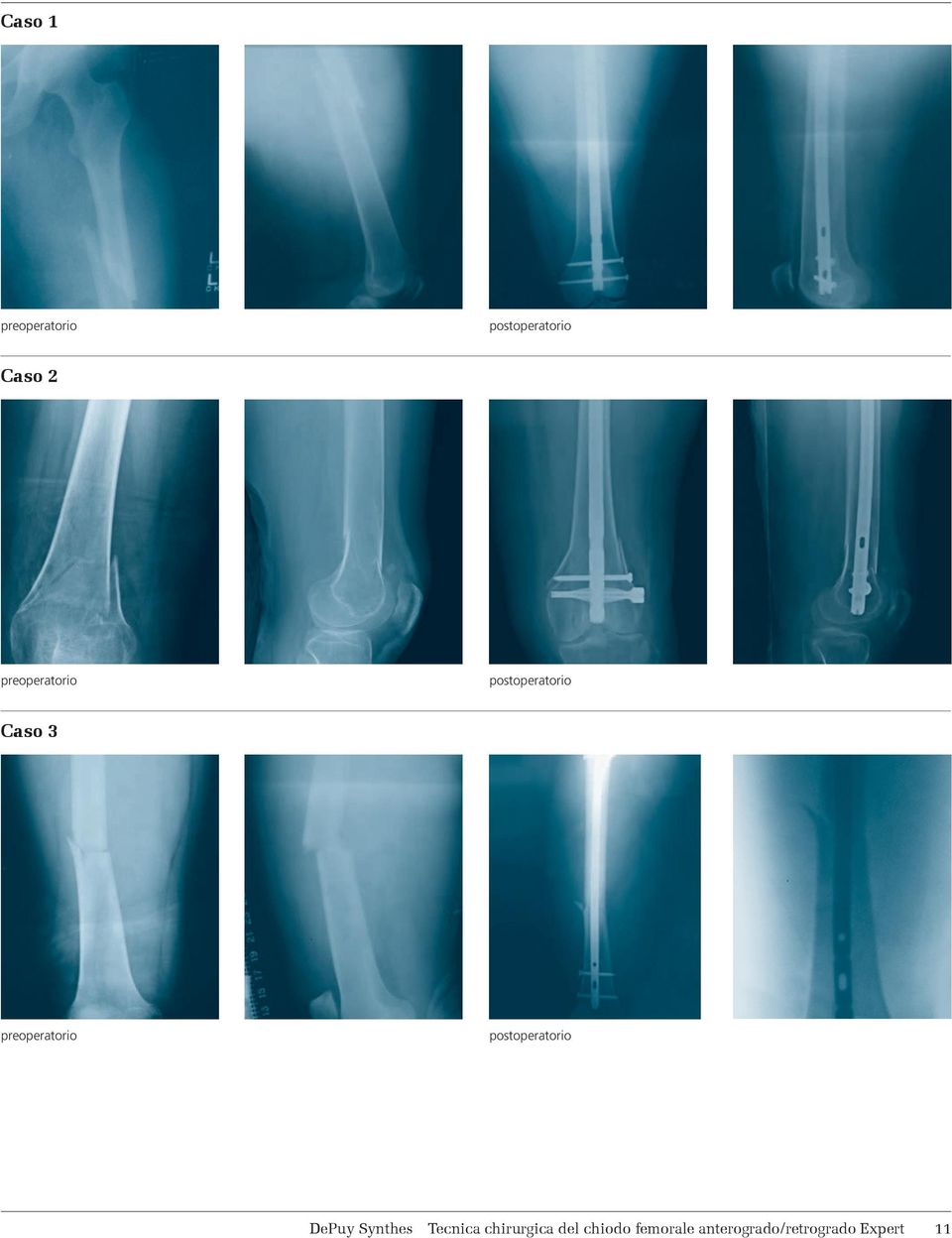 preoperatorio postoperatorio DePuy Synthes