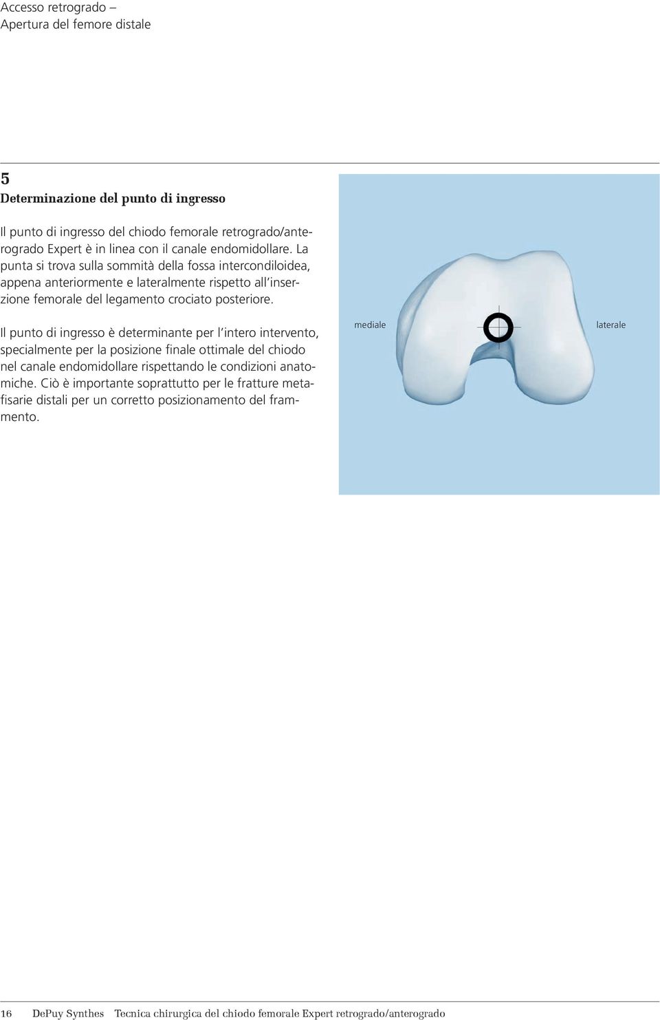 Il punto di ingresso è determinante per l intero intervento, specialmente per la posizione finale ottimale del chiodo nel canale endomidollare rispettando le condizioni anatomiche.