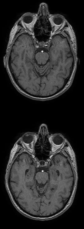 MRI: atrofia temporo-mesiale, temporale laterale e parietale,