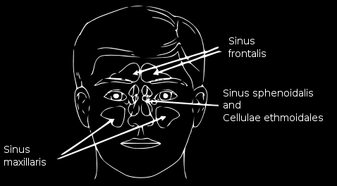La sinusite è l infiammazione della mucosa che riveste i seni paranasali, piccole cavità scavate nelle ossa del volto in corrispondenza degli zigomi, della fronte, della mascella e ai lati del naso.
