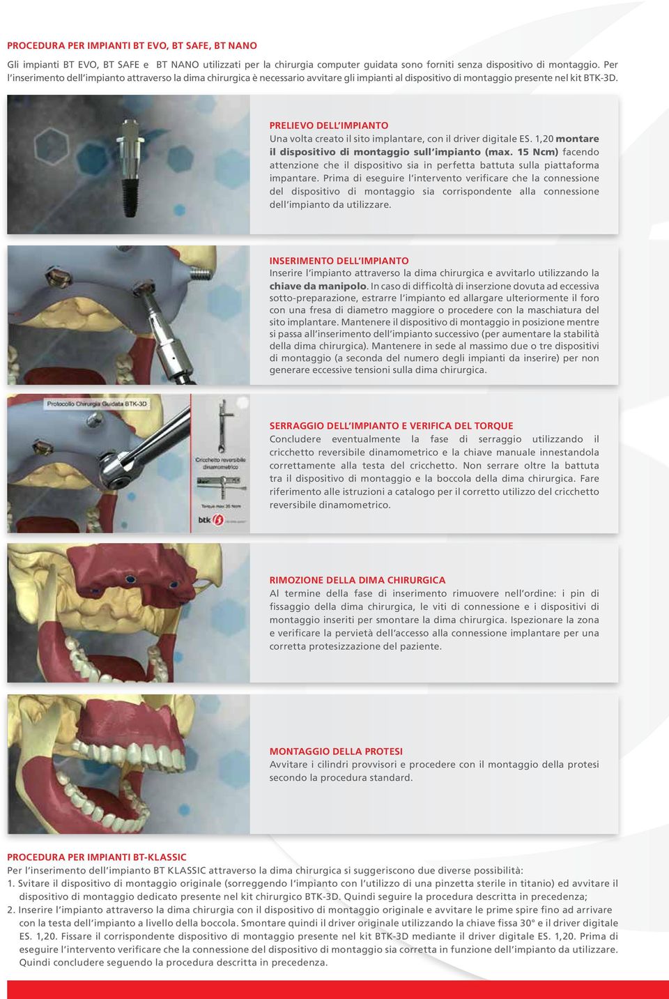 PRELIEVO DELL IMPIANTO Una volta creato il sito implantare, con il driver digitale ES. 1,20 montare il dispositivo di montaggio sull impianto (max.