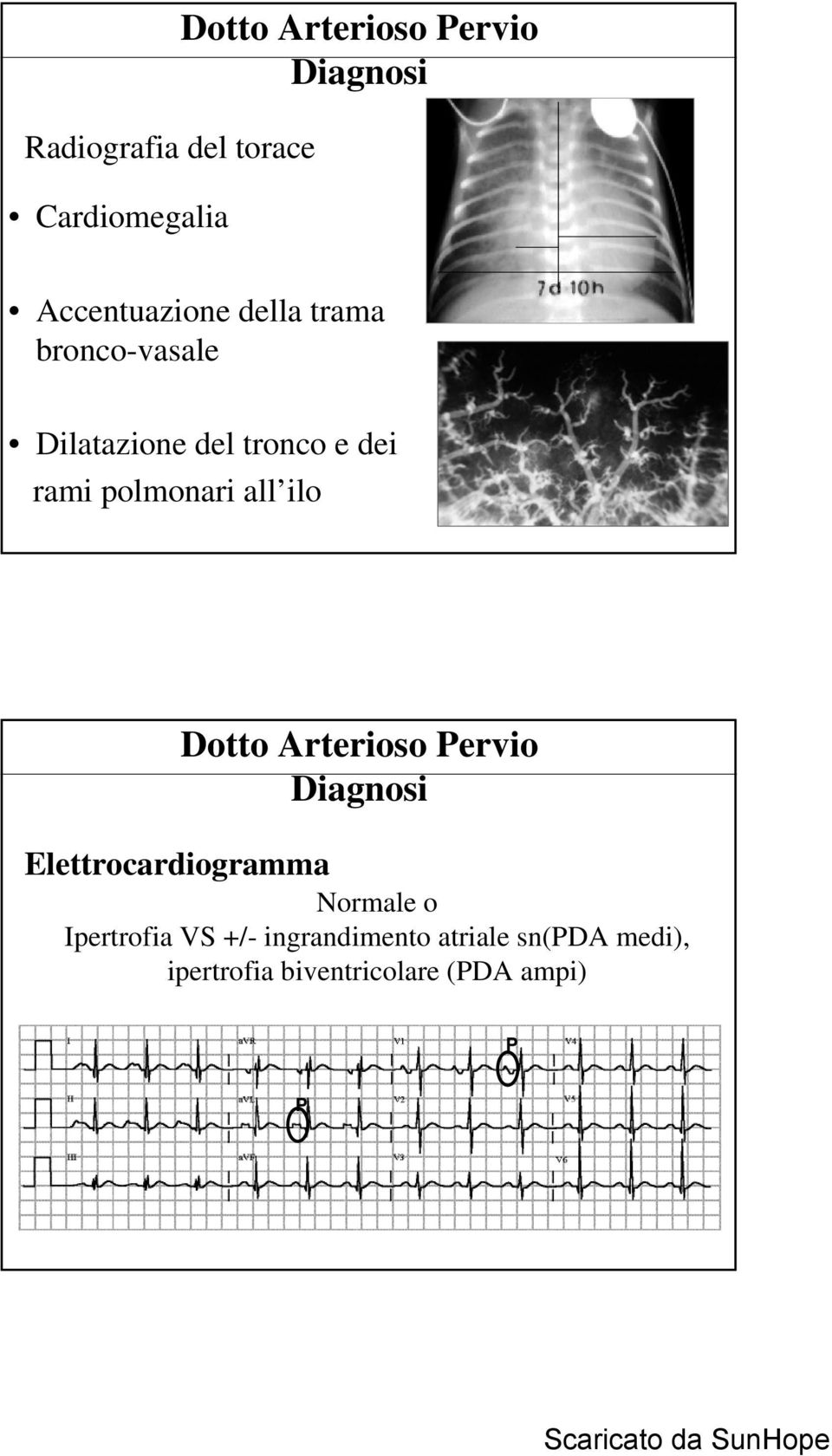 ilo Elettrocardiogramma Diagnosi Normale o Ipertrofia VS +/-