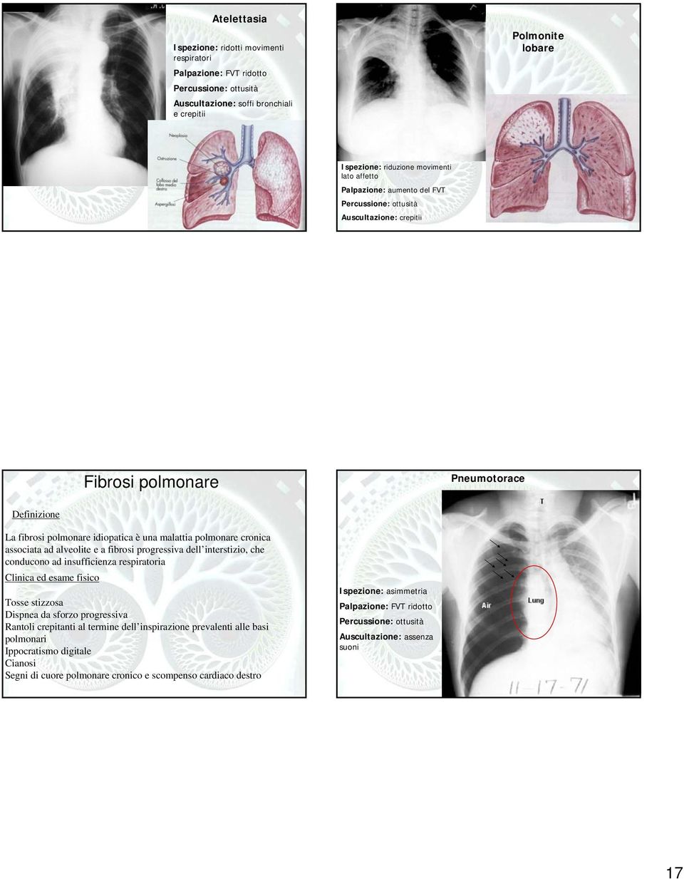 ad alveolite e a fibrosi progressiva dell interstizio, che conducono ad insufficienza respiratoria Clinica ed esame fisico Tosse stizzosa Dispnea da sforzo progressiva Rantoli crepitanti al termine