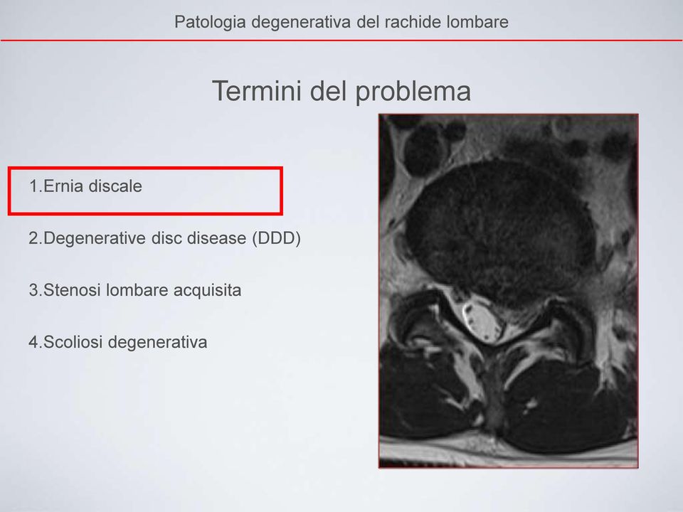 Degenerative disc disease