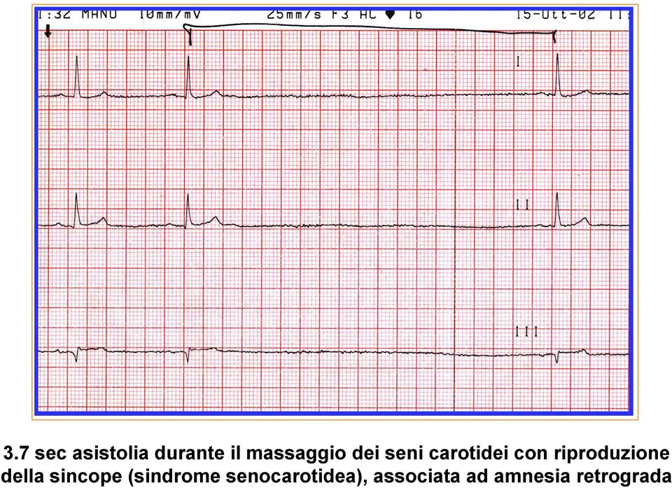 riproduzione della sincope (sindrome