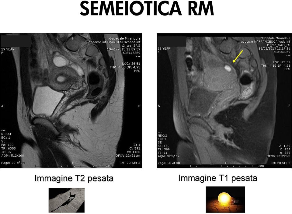 T2 pesata