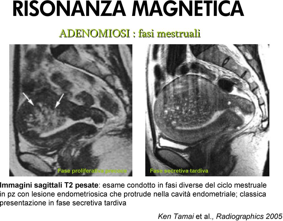 mestruale in pz con lesione endometriosica che protrude nella cavità