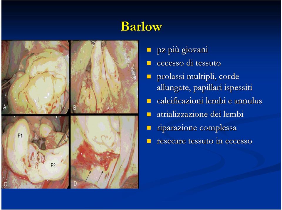 calcificazioni lembi e annulus atrializzazione dei