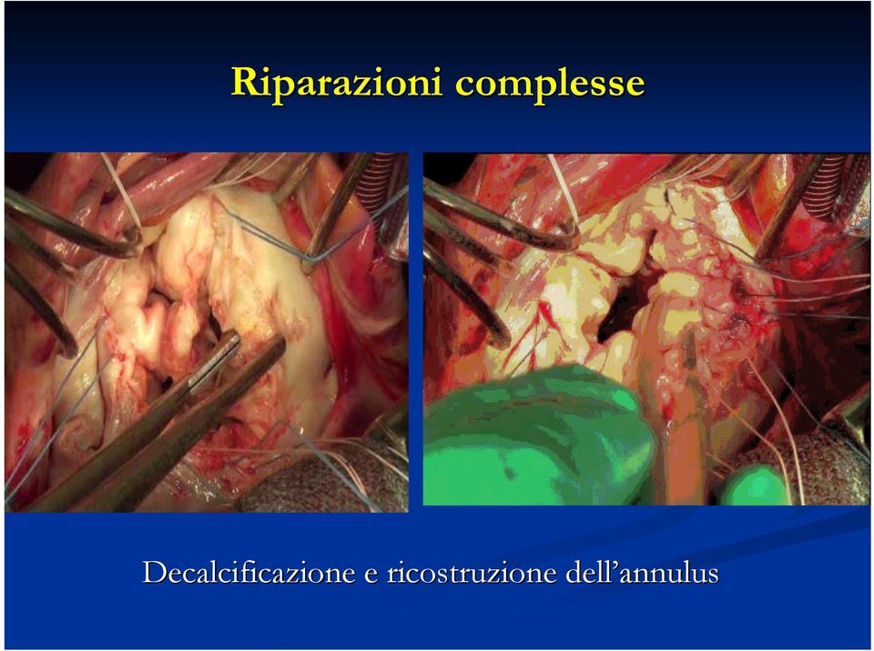 Decalcificazione