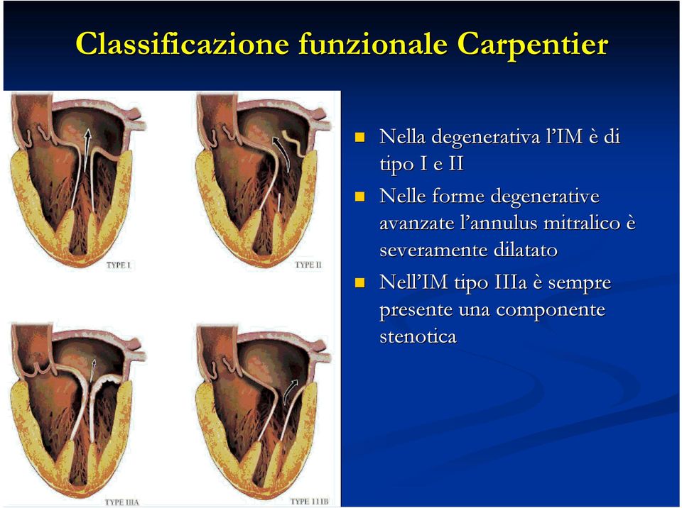 degenerative avanzate l annulus mitralico è