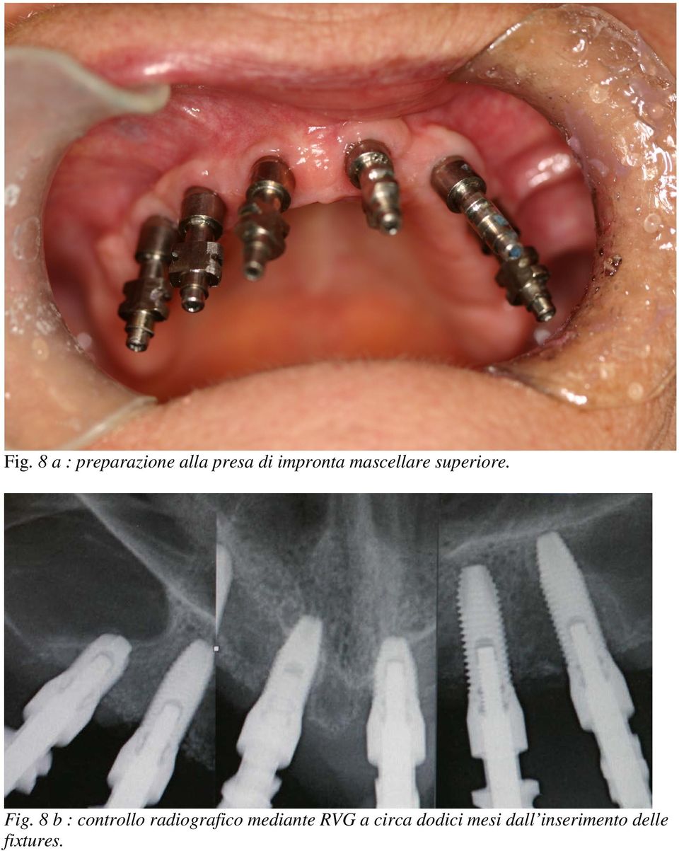 8 b : controllo radiografico mediante RVG