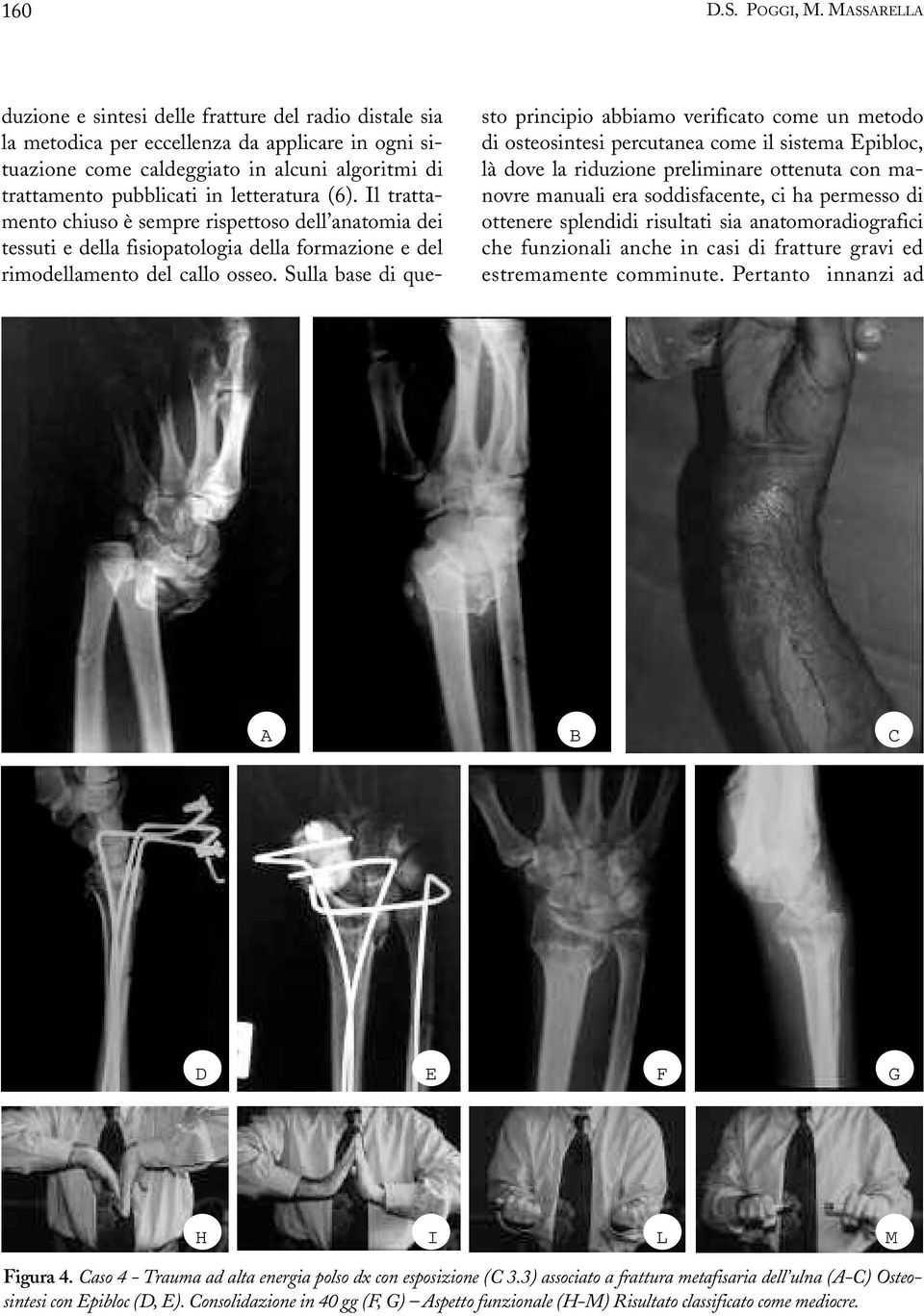 Sulla base di questo principio abbiamo verificato come un metodo di osteosintesi percutanea come il sistema Epibloc, là dove la riduzione preliminare ottenuta con manovre manuali era soddisfacente,