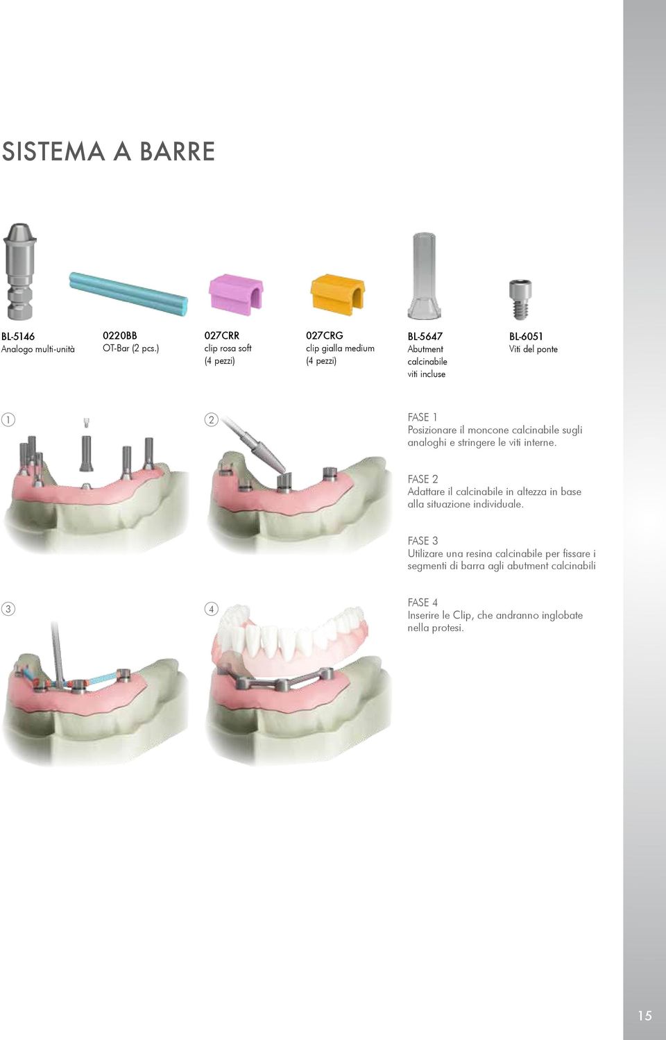 ponte 1 2 FASE 1 Posizionare il moncone calcinabile sugli analoghi e stringere le viti interne.