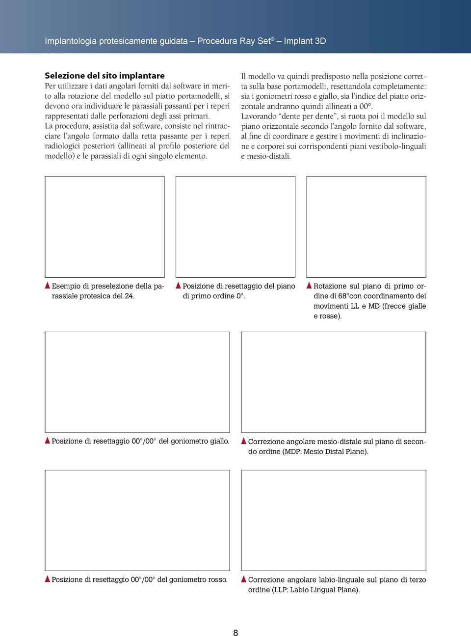 La procedura, assistita dal software, consiste nel rintracciare l angolo formato dalla retta passante per i reperi radiologici posteriori (allineati al profilo posteriore del modello) e le parassiali