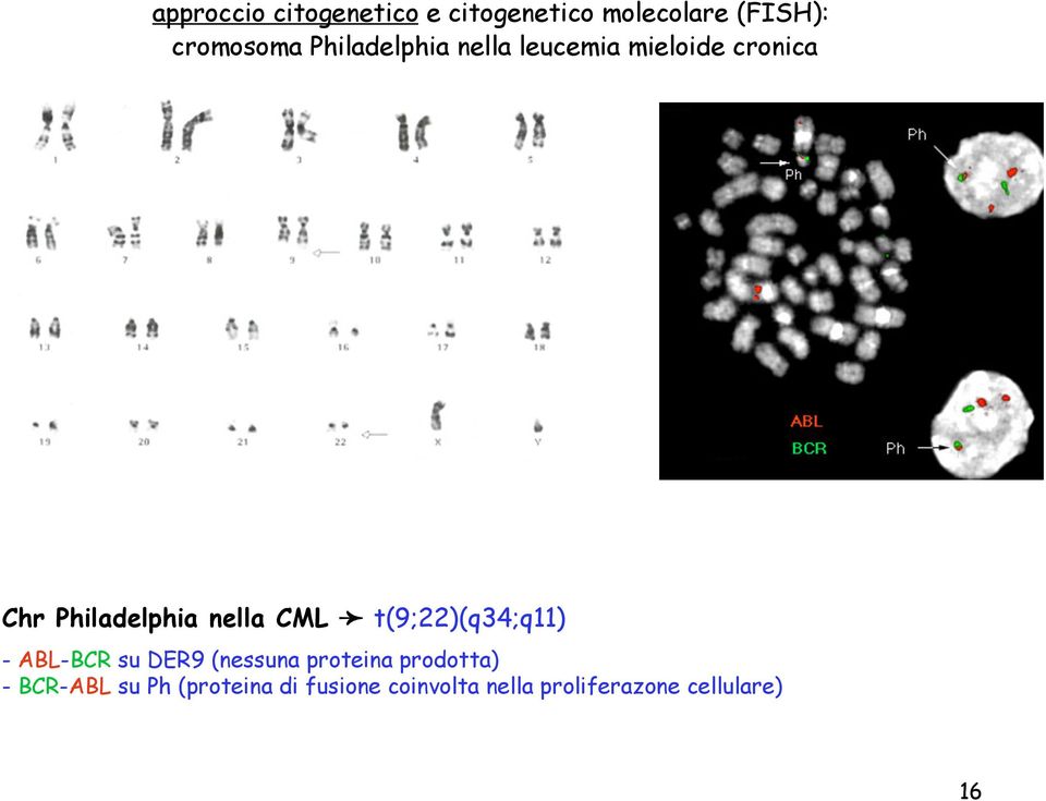 CML t(9;22)(q34;q11) - ABL-BCR su DER9 (nessuna proteina prodotta) -
