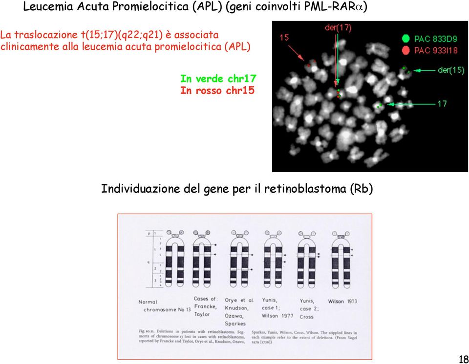 alla leucemia acuta promielocitica (APL) In verde chr17 In